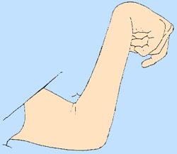 Wrist flexion contracture.gif